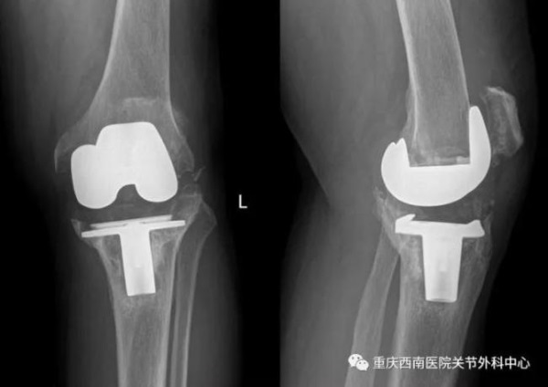 3D打印膝關(guān)節